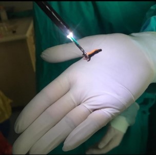 Çiğnediği Karanfil Akciğerine Kaçınca Ölümden Döndü