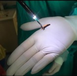 PAMUKKALE ÜNIVERSITESI - Çiğnediği Karanfil Akciğerine Kaçınca Ölümden Döndü