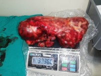 GENETIK - Karın Ağrısı Şikayetiyle Geldi, Karnından 4 Kilo Kitle Çıktı