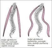 BÖBREK YETMEZLİĞİ - Omurga Yetmezliğine Dikkat