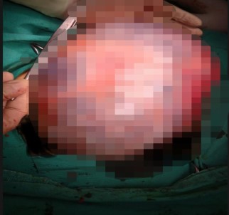 Tam 30 Santimetre Açıklaması Genç Kadının Karnından Operasyonla Alındı