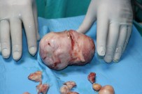 AMELIYAT - Karnından 15 Santimlik Miyom Çıktı