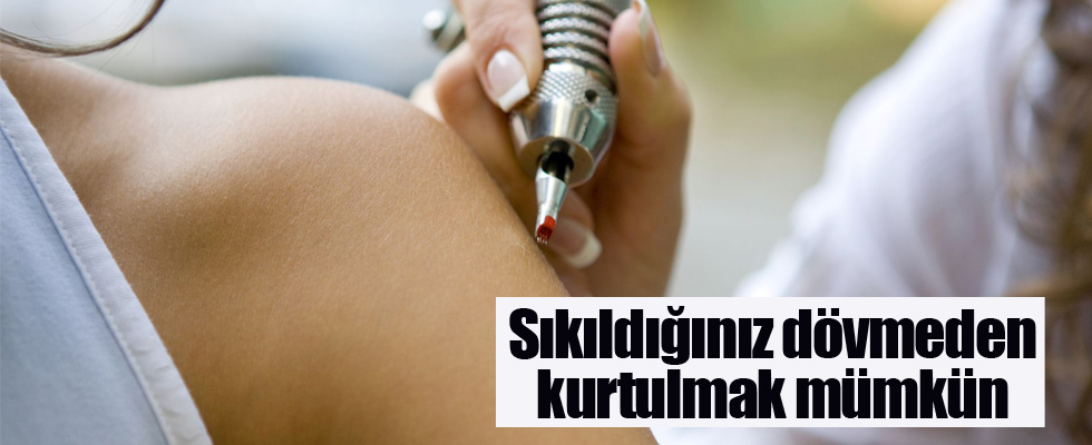 Sıkıldığınız dövmeden kurtulmak mümkün