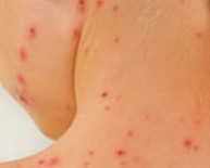 BROOKLYN - New York'ta Kızamık Alarmı Açıklaması Acil Durum İlan Edildi