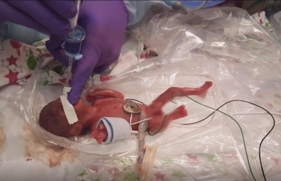 Dünyanın En Küçük Bebeği Yaşam Mücadelesini Kazandı