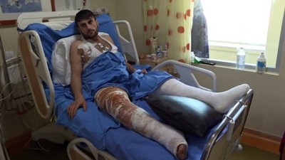 Yangını Söndürmek İsterken Bacaklarından Oluyordu