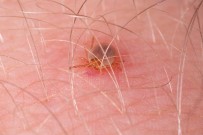 İSTANBUL AYDIN ÜNİVERSİTESİ - KKKA'da Kene Tutunmasında Dikkatli Olunmalı