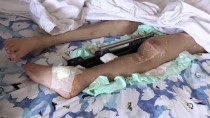 MUSTAFA KEMAL ÜNIVERSITESI - Suriyeli Çocuk Vücudunda Şarapnel Parçalarıyla Yatağa Mahkum Yaşıyor