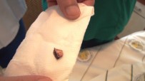 KEMİK PARÇASI - Çorba içerken akciğerine kaçan kemik 3 yıl sonra fark edildi