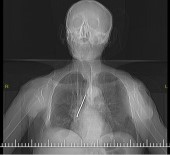 FETHİ SEKİN - Soluk Borusuna Kaçan 10 Santimlik Çivi Çıkarıldı