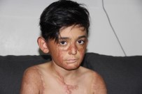 (Özel) Vücudu Yanan Umut'un Acı Çığlığı Açıklaması 'Eski Derimi İstiyorum'