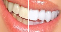 KANAL TEDAVISI - Dişlerde Renk Değişimine Dikkat