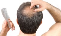 ŞENYURT - Erkeklerin Büyük Sorunu Saç Dökülmesi