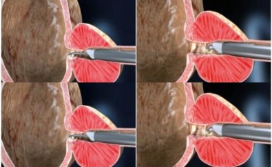 Prostat Tedavisinde 'Plazma Kinetik TUR Yöntemi' İle Başarılı Sonuçlar Alınıyor