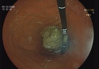 Çekirdekleriyle Alıç Tüketen 5 Kişi Hastanelik Oldu