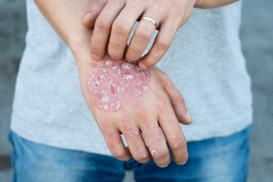 'Soğuk Hava Psoriasis'i Şiddetlendiriyor'