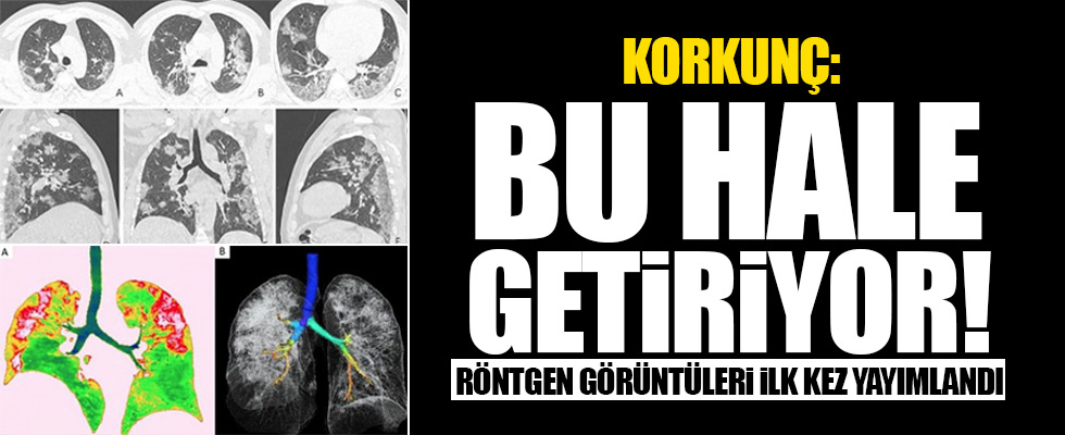 Röntgen filmleri ilk kez yayınlandı!