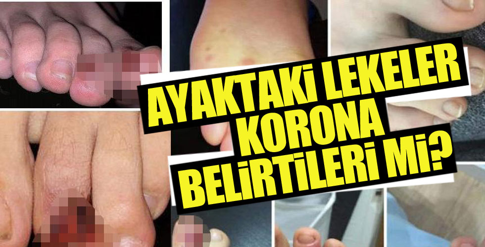 Ayaktaki lekeler coronanın işareti mi?