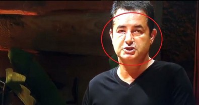 Acun'un yüzündeki şişliğin sebebi...