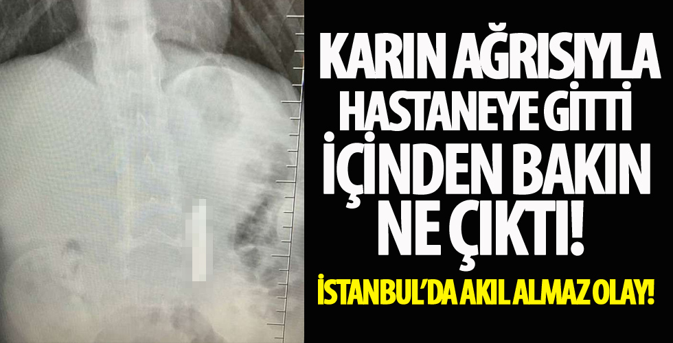 Karın ağrısıyla hastaneye gitti içinden bakın ne çıktı?