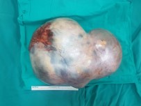 17 Yaşındaki Kızın Karnından 5 Kiloluk Tümör Çıktı, Doktor Gözlerine İnanamadı