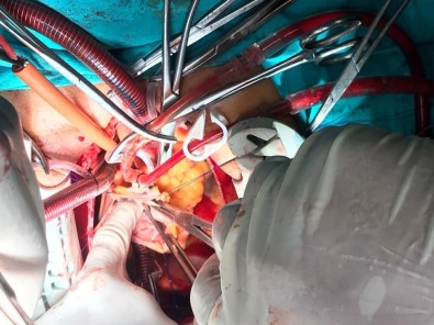 Afyonkarahisar'da Kalbe Yerleşen 5 Santimlik Tümör Ameliyatla Alındı