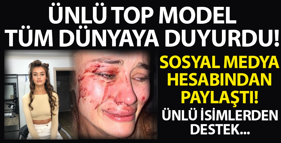 Dünyaca ünlü top model Çeşme'de darp edildi!
