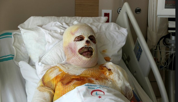 Çay yaparken canından oluyordu!