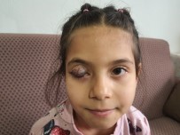 Göz Kapağında Doğuştan Tümör Bulunan 7 Yaşındaki Beyza'nın Yardım Çığlığı