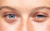 GÖZ KAYMASI - Göz Kayması Neden Olur? Göz Kayması Tedavisi