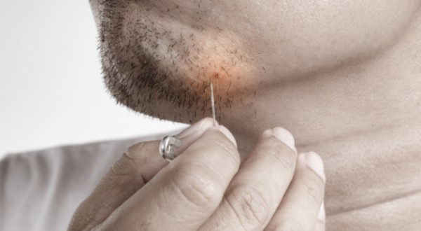 Kıl Dönmesi Nedir? Kıl Dönmesi Neden Olur?