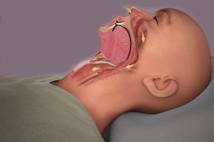 Horlama Neden Olur? Horlama Tedavisi