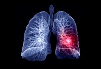 Koronavirüs, akciğer hastalarında uzun süren sorunlara neden oluyor