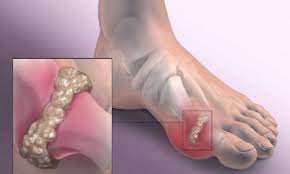 Gut Hastalığı Nedir? Gut Hastalığı Belirtileri