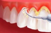 DİŞ TAŞI - Diş Taşı Nasıl Temizlenir? Diş Taşı Neden Olur? Diş Taşı Zararları