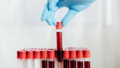 CRP Yüksekliği Nedir? CRP Yüksekliği Neden Olur? CRP Yüksekliği Nasıl Tedavi Edilir?