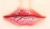 DUDAK ÇATLAMASI - Dudak Çatlaması Neden Olur? Dudak Çatlaması Nasıl Geçer?