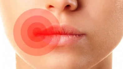 Uçuk Neden Olur? Dudakta Uçuk Nasıl Geçer?