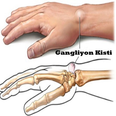 Bilek Kisti Neden Olur? Bilek Kisti Ameliyatı Nasıl Yapılır?