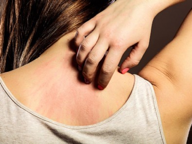 Uyuz Nasıl Geçer? Uyuz Belirtileri