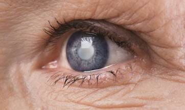 Katarakt Nasıl Olur? Katarakt Belirtileri