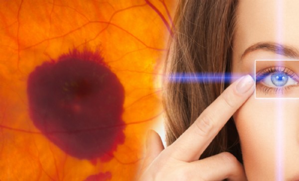 Sarı Nokta Hastalığı Nedir? Sarı Nokta Hastalığı Belirtileri