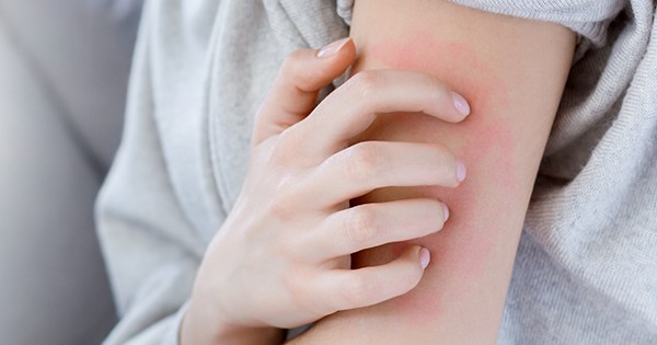 Uyuz Nasıl Geçer? Uyuz Belirtileri