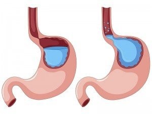 Gastrit Neden Olur? Gastrit Belirtileri Nelerdir?