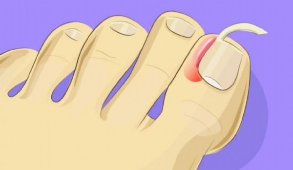 Tırnak Batması Neden Olur? Tırnak Batması Nasıl Geçer?