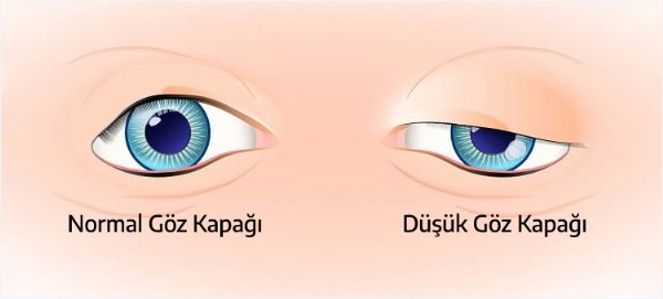 Göz Kapağı düşüklüğü Neden Olur? Göz Kapağı Düşüklüğü Tedavisi