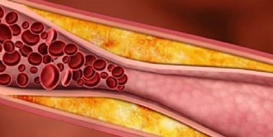 Kolesterol Belirtileri Nelerdir? Kolesterol Nasıl Anlaşılır?