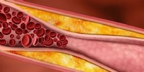 KOLESTEROL - Kolesterol Belirtileri Nelerdir? Kolesterol Nasıl Anlaşılır?