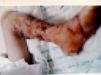 4 Yil Önce Pitbull Saldirisina Ugrayan Çocuk, Psikolojik Tedavi Aliyor