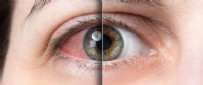 GÖZ KIZARIKLIĞI - Göz Kızarıklığı Neden Olur? Göz Kızarıklığı Nasıl Geçer?